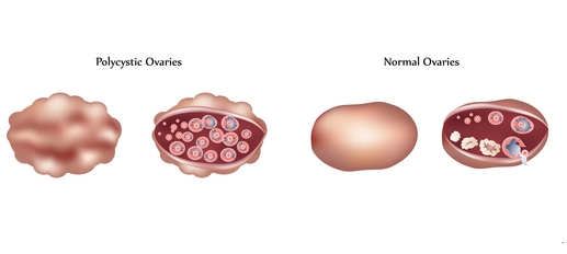 polycystic ovaries, PCOS